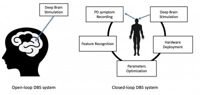 A closed loop system is a circular response to when a patient needs stimulus, incuding PD symptom recording, feature recognition, Parameters optimization, hardware deplayment, and deep brain stimulation, as shown in a circular format, while and open-loop system show provides continuous deep brain stimulation whether the patient needs it or not. A closed loop system is a circular response to when a patient needs stimulus, incuding PD symptom recording, feature recognition, Parameters optimization, hardware deplayment, and deep brain stimulation, as shown in a circular format, while and open-loop system show provides continuous deep brain stimulation whether the patient needs it or not.